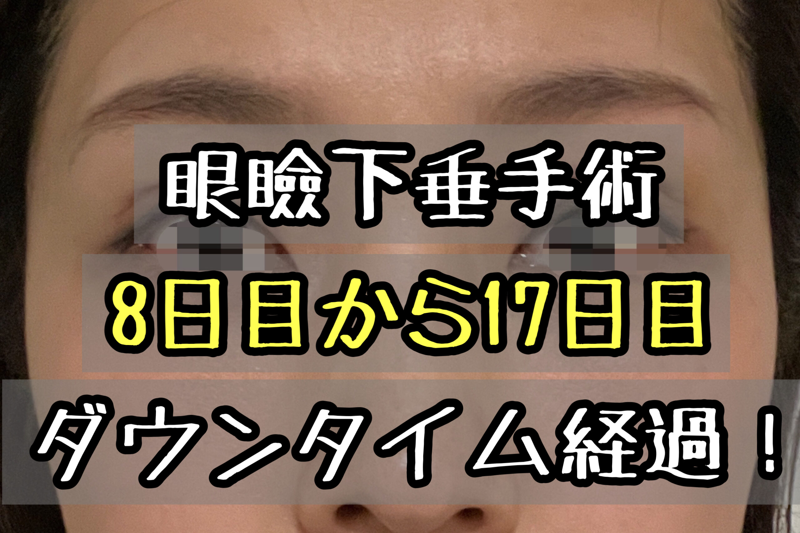 眼瞼下垂手術のダウンタイム経過ブログ 抜糸後の腫れの引き方が早い メメコメモ